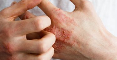 Eczema: causes, symptoms, diagnosis and treatment