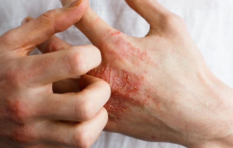 Eczema: causes, symptoms, diagnosis and treatment