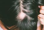 Alopecia causes, symptoms and treatement