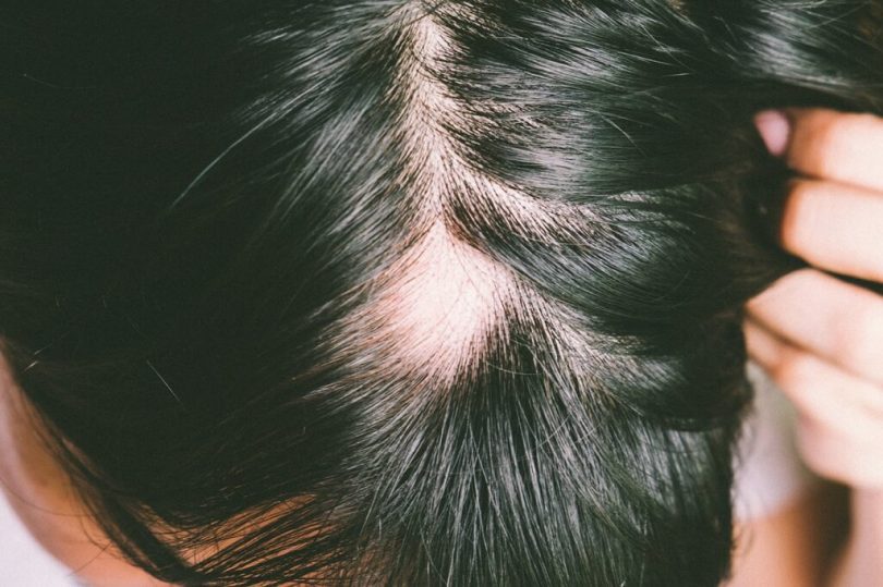 Alopecia causes, symptoms and treatement