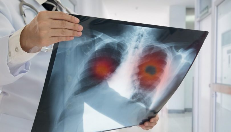 Asbestosis causes, symptoms and treatment