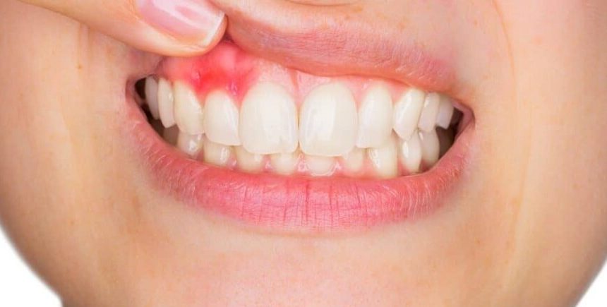  Tooth abcess symptoms