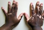 Vitiligo causes, symptoms and treatment