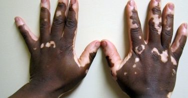 Vitiligo causes, symptoms and treatment